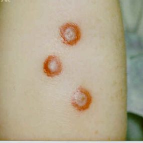 Erythematous nodules on the extremities