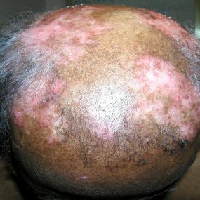 Pruritic rash with alopecia