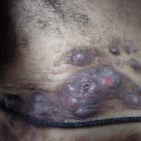 Translucent and Hyperpigmented Papules and Nodules on the Upper Back and Neck