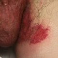 Pruritic Painful Groin Rash