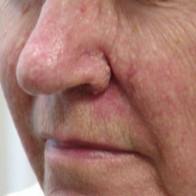 Multiple Papules on Cheeks and Nose