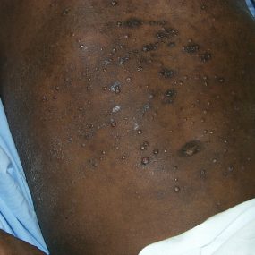 Disseminated Papules