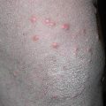 Sudden Onset of Disseminated Papules