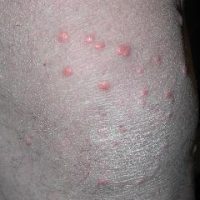 Sudden Onset of Disseminated Papules