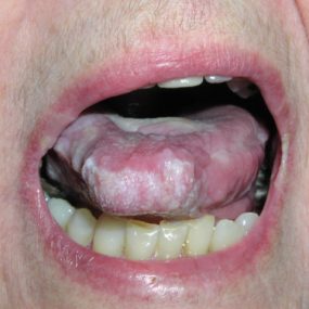 Painful Lesions in the Mouth