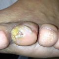 Pruritic, painful callus on the toe