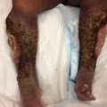 Lesions on bilateral legs