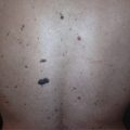 Multiple seborrheic keratosis on the back