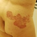 Rash in nursing home patient