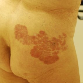 Rash in nursing home patient