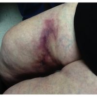 Rapidly expanding necrotic plaques in an elderly woman