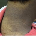 Persistent and progressive hyperpigmented patches