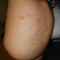 Atrophic dermatosis on bilateral legs