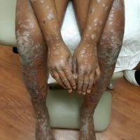 Worsening rash in female with history of cord blood transplant