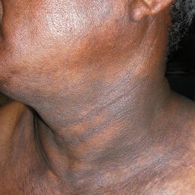 Darkish discoloration of skin involving the back, neck, and upper arms