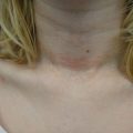 Lesions on the neck