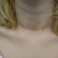 Lesions on the neck