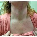 Long standing upper body rash