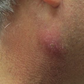 54 year old man with multiple sores