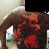 Generalized rash in 33 year-old female