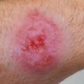 Ulcerative lesions in returning travelers