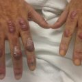 Burning and stinging red nodules on the dorsum of hands