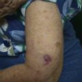 Violaceous nodule of the upper extremity