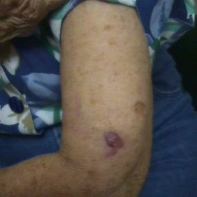 Violaceous nodule of the upper extremity