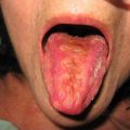 Large yellow plaque on the tongue