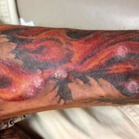 Multiple nodules arising in a tattoo