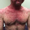 Rapidly progressive erythema