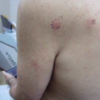 A 53-year-old male with pruritic red papules