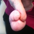 Enlarging tumor on the finger