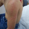 Pruritic erythematous rash after sun exposure