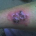 Atypical rash on the right forearm