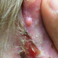 Retroauricular ulcer in a patient with a history of multiple skin cancers