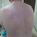 65-year-old gentleman with erythematous induration of the skin on his back