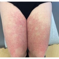 Unusual vascular rash to trunk and extremities