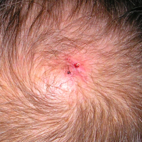 Nodule on the vertex of the scalp