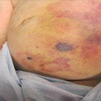 Atypical vascular lesion arising in an area of previous radiation treatment on the breast