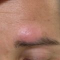 New onset eyebrow alopecia