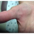 58yo female with hyperpigmented papules on arms and palms