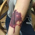 Purpuric rash in a 40-year old female abusing cocaine