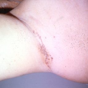 Unilateral hyperpigmented axillary eruption