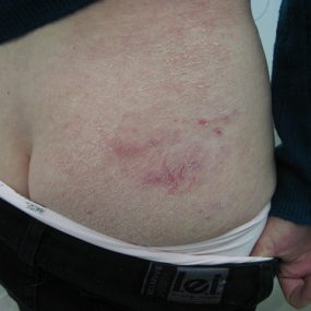 Non pruritic erythematous patch