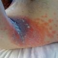 Rash in hospitalized patient