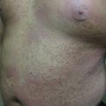 Pruritic rash involving upper torso and extremities