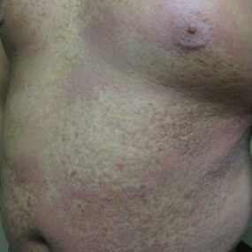 Pruritic rash involving upper torso and extremities