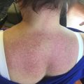 Pruritic rash with proximal muscle weakness