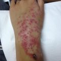 Spreading rash from left wrist